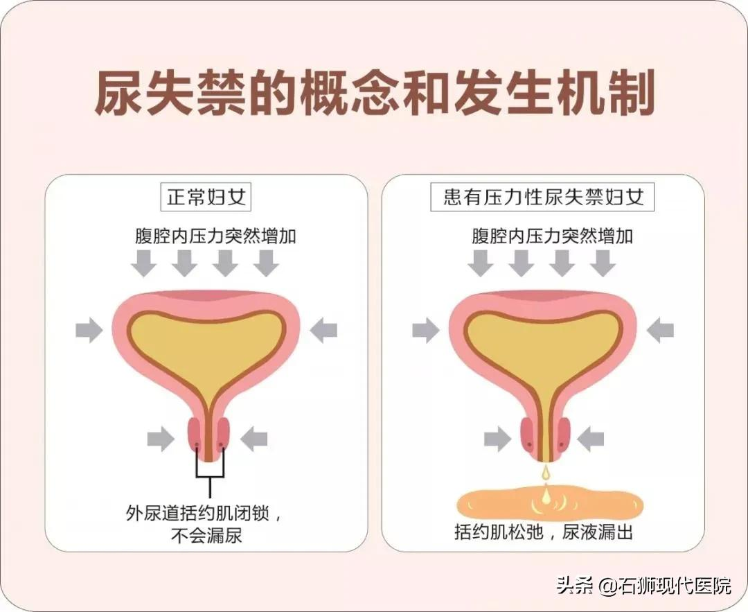 一笑就“湿身”？10几年痛苦一次解决