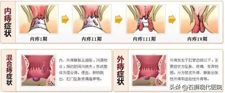 羞涩的肛门指检丨石狮现代医院肛肠外科一患一医一诊室 患者不尴尬