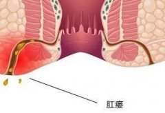 肛瘘若不及时治疗，对身体有哪些危害