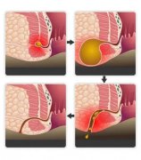肛瘘是怎么引起的？如何判断自己得了