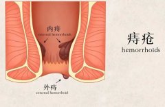 痔疮小贴士：“痔”了会不会发生癌变