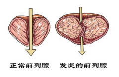 前列腺炎很常见，但是危害却不能忽视