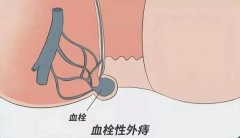 肛门周边长了颗“紫葡萄”？其实是血