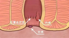 内痔、外痔、混合痔，你区分清楚了吗