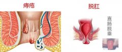 肛门掉出小“肉球” ，需警惕四种肛肠