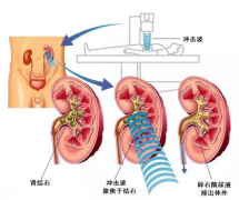 石狮现代医院体外碎石，帮你解决结石