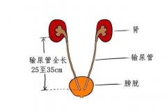 输尿管三个狭窄，是输尿管结石引发肾