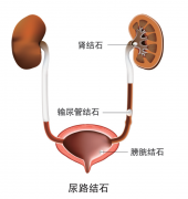 尿路结石，难以言喻的疼！