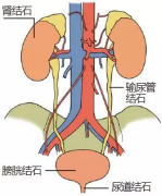 体外冲击波碎石是治疗尿结石的首选