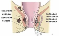 肛瘘有哪些症状？怎么治疗？
