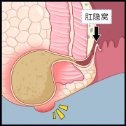 警惕！肛肠三大疾病之一——肛周脓肿