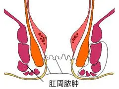 肛周脓肿该怎么治疗，需要手术吗？听