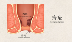 害怕做肛肠检查？一文带你了解肛肠疾