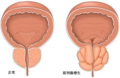 做好五点，保护好你的前列腺！