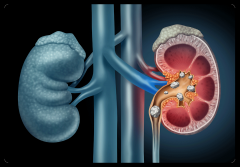 为什么肾脏里会有“石头”？肾结石要