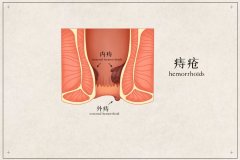 关于痔疮，你关心的常见问题解答都在