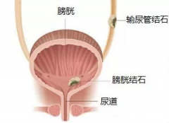 藏在身体里“鸡蛋大小”的结石