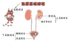 夏天来了，泌尿系结石又搞“偷袭”？