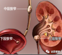 尿路结石 长期会造成哪些影响？