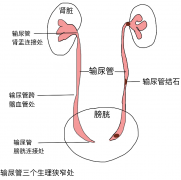 输尿管结石我们要怎么处理？