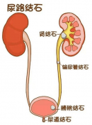 结石虽小，疼起来要命