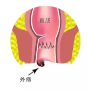 痔疮发作，让人难以忍受！