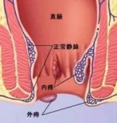 痔疮手术真的很疼吗？什么情况下需要