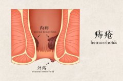 治疗内痔后，如何呵护好“菊花”？