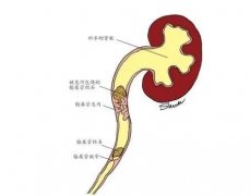 得了肾结石怎么办？