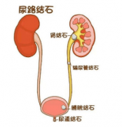 得了肾结石别慌，科学治疗是关键