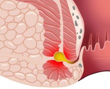 肛瘘的三大预警表现，不治疗会有什么