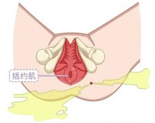 肛瘘如何“步步为营”，只为让你尝尝