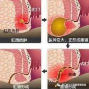 肛瘘手术怎么选择才能高枕无忧？