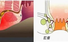 重视肛瘘危害！为自己的身体及时堵上