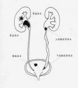 结石碎了又长，难根治？预防泌尿系结