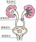 泌尿系长了石头怎么办？可以预防吗？