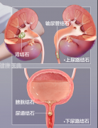 远离“生命剧痛——泌尿结石” ，防治