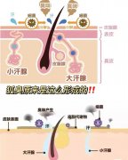 清除腋臭微创新技术—精确又安全！