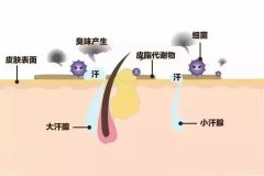 选对治疗方法 跟腋臭说拜拜！