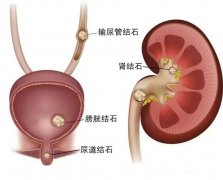 肾结石为什么会“晚上发作”？肾结石