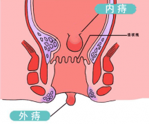 “十人九痔”，我的外痔该咋办？