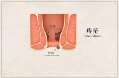 五大症状提示你患上了痔疮，赶紧来看