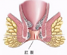 每次大便像拉玻璃碴子一样，是肛门裂