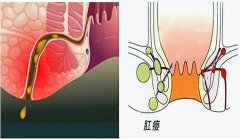 肛瘘怎么治疗比较好?