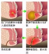 肛瘘？别担心，我们一起面对它！