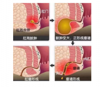 肛瘘无法自愈，必须手术才能治疗吗?