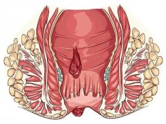 肛肠疾病久拖不治，小问题变成大危害