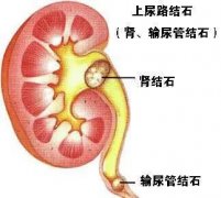 石狮尿道结石疼痛怎么才能缓解疼痛