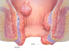 石狮外痔手术要多少钱？