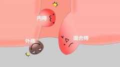 内痔、外痔、混合痔……痔疮的三种分